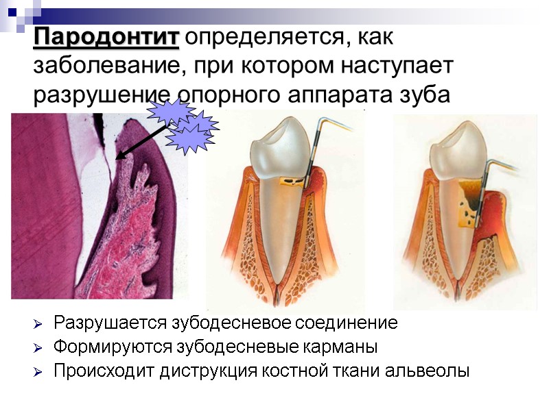 Пародонтит определяется, как заболевание, при котором наступает разрушение опорного аппарата зуба Разрушается зубодесневое соединение